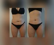 Gommage corporel Celloo au café et aux huiles naturelles pour réduire la cellulite et les vergetures