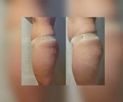 Gommage corporel Celloo au café et aux huiles naturelles pour réduire la cellulite et les vergetures