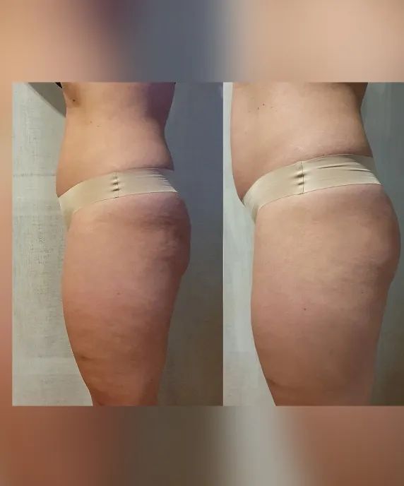 Ventosa para celulitis antes y después best sale